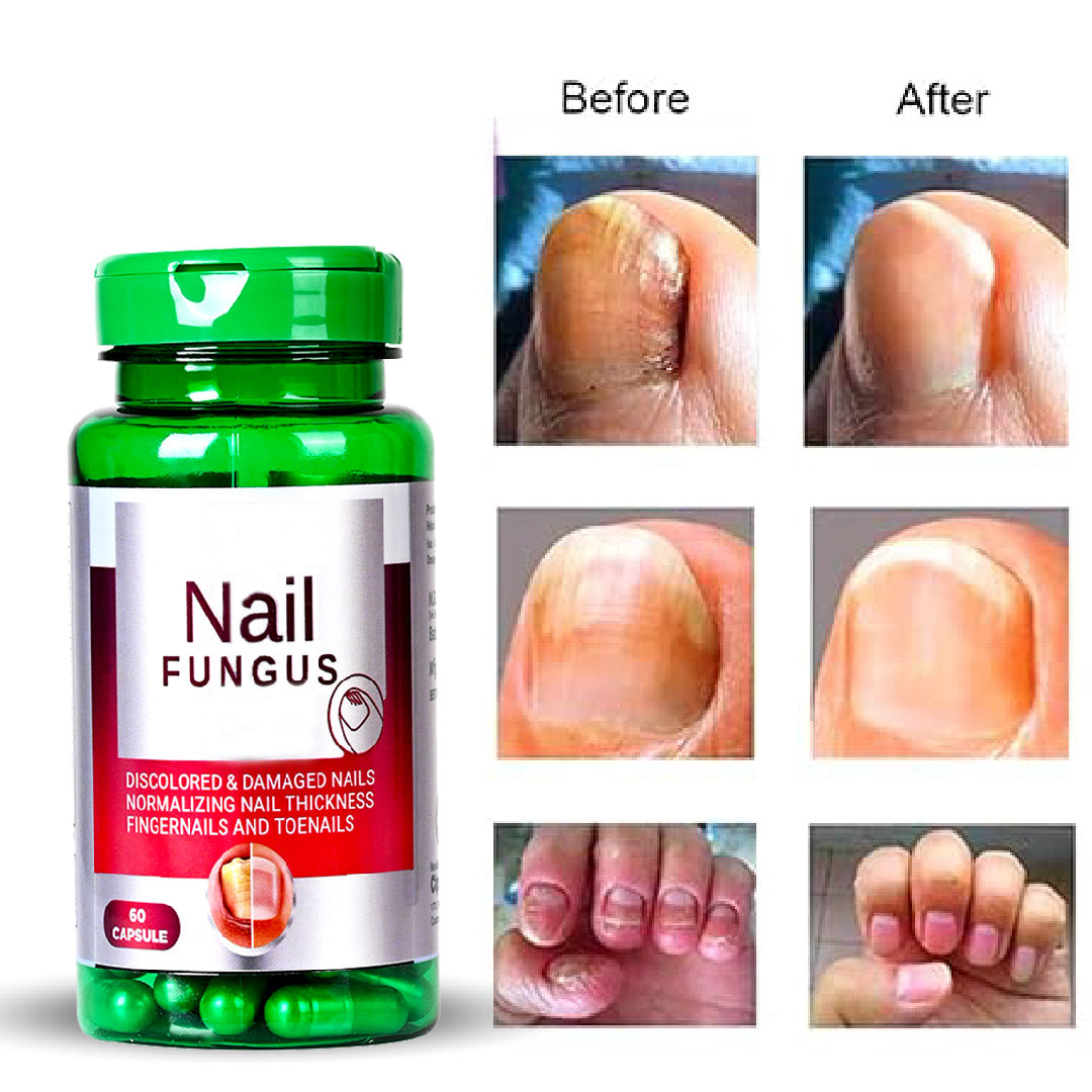 Nail Fungus Capsule