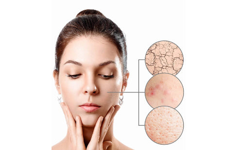 reduce_skin_acne